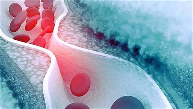 Η υψηλή χοληστερόλη LDL αυξάνει τον κίνδυνο καρδιοπάθειας ακόμα και σε ‘’υγιείς’’ ανθρώπους