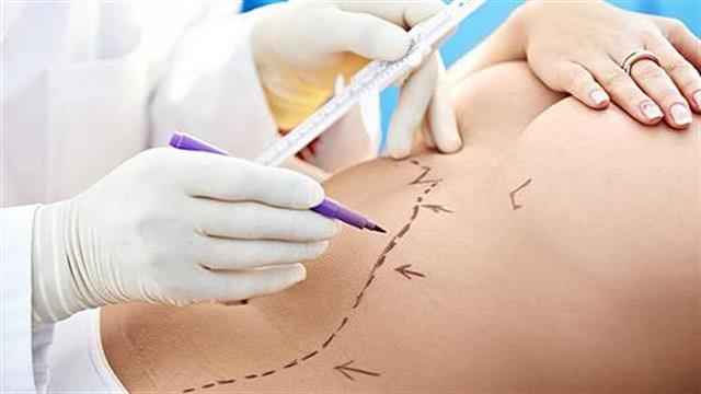 Κοιλιοπλαστική: Όσα πρέπει να ξέρετε