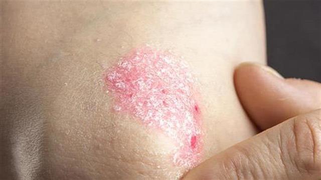 Σημαντικές εξελίξεις στη θεραπεία της ψωρίασης