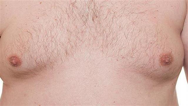 Γυναικομαστία: οι πιο συχνές ερωτήσεις