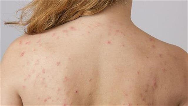 Πώς να απαλλαγείτε από την ακμή στην πλάτη και στους ώμους