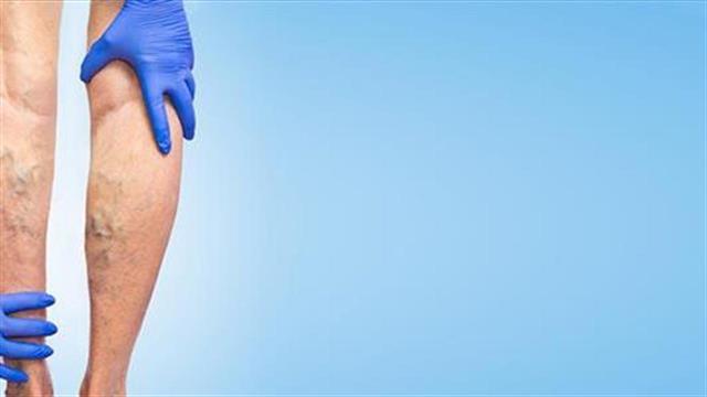 Οι ψηλοί κινδυνεύουν περισσότερο από την εμφάνιση κιρσών