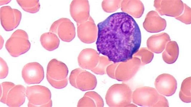 Λευχαιμία: Τα νεότερα δεδομένα