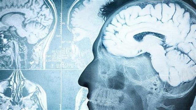 Πολλαπλή σκλήρυνση: Εντοπίστηκε ένζυμο που προκαλεί αυτοάνοση αντίδραση από τα  κύτταρα Τ