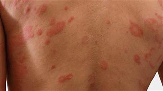 O ΕΜΑ συνιστά τη χορήγηση άδειας σε μονοκλωνικό αντίσωμα για το κληρονομικό αγγειοοίδημα