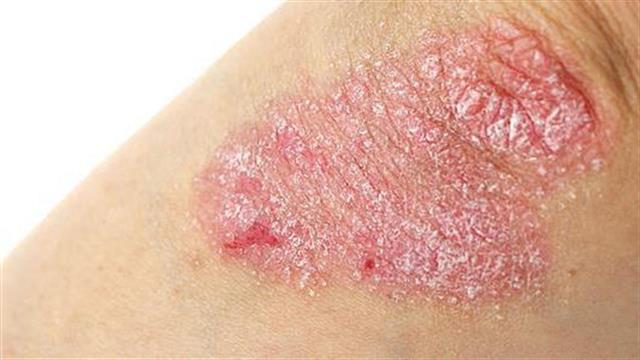 Ψωρίαση: Μία χρόνια, μη μεταδοτική ασθένεια