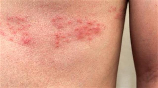 Ο έρπητας ζωστήρας μπορεί να εκδηλωθεί στον καθένα