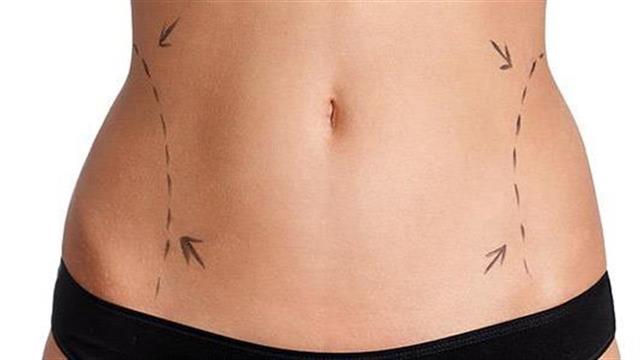 Eξελίξεις στη λιποαναρρόφηση