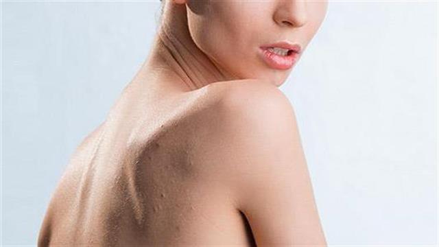 Γιατί έχω ακμή στην πλάτη;