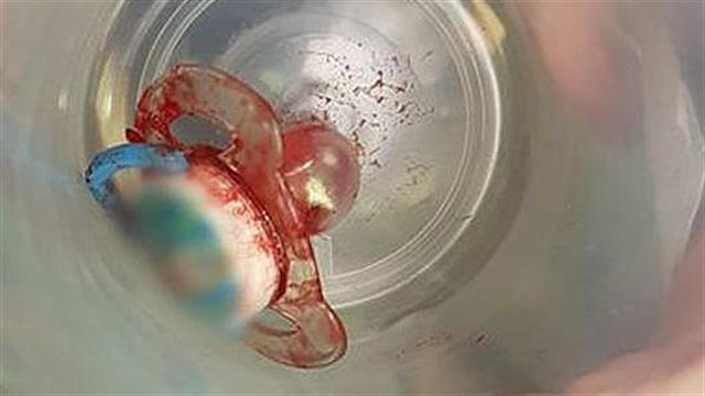 Αντιμετωπίστηκε με επιτυχία μωρό που κατάπιε την πιπίλα του