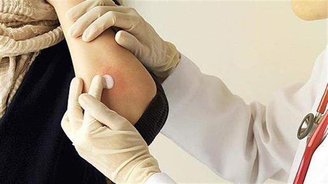 Στα 10.000 ευρώ το ετήσιος κόστος για το brodalumab