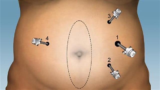 Πρωτοποριακή επέμβαση κοιλιοκήλης στο Metropolitan Hospital