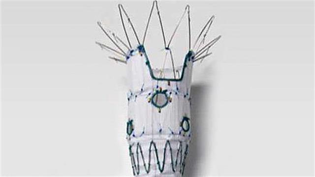 Νέα πρωτοποριακή τεχνική για τη θεραπεία υπερνεφρικού ανευρύσματος της αορτής