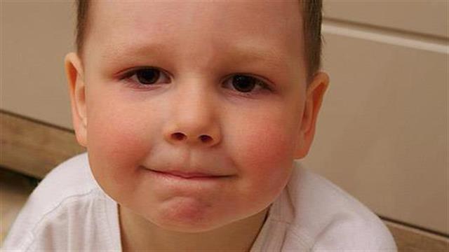 Πώς θα φροντίσω την ατοπική δερματίτιδα στο παιδί μου;