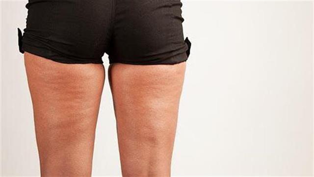 Οι top θεραπείες για κυτταρίτιδα και τοπικό πάχος