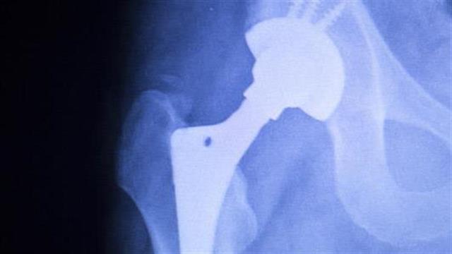 Ταχύτερη ανάρρωση με την  ολική αρθροπλαστική ισχίου με την μέθοδο "Superpath"