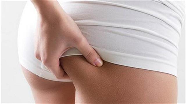 Κυτταρίτιδα: Πώς δημιουργείται και πώς να την αντιμετωπίσεις