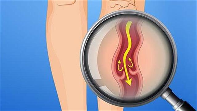 "Βαριά" πόδια; Έξυπνες κινήσεις για να βελτιώσεις την καθημερινότητά σου!