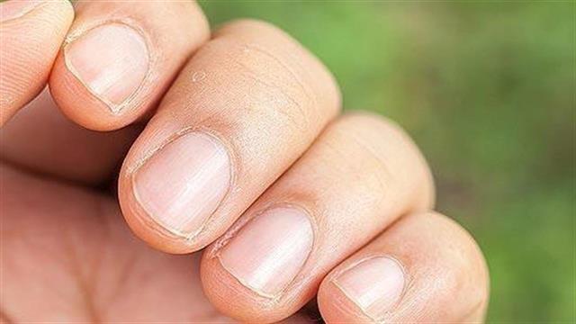 Πως θα σταματήσω να τρώω τα νύχια μου;