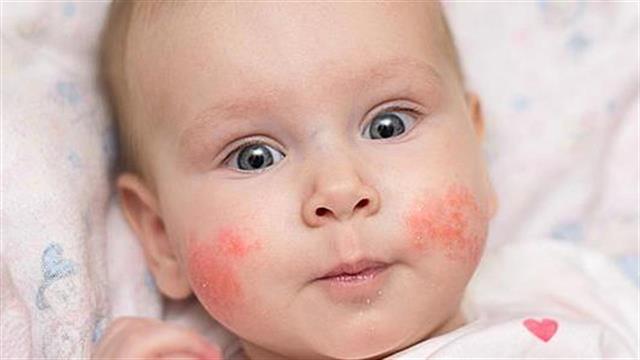 Πώς αντιμετωπίζεται η ατοπική δερματίτιδα