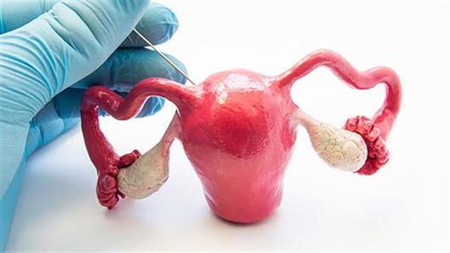 Τι πρέπει να γνωρίζεις για τις κύστεις στην ωοθήκη