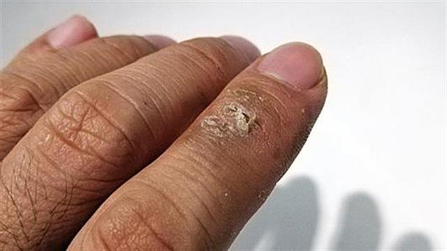 Τι είναι το σκληρόδερμα και με ποια χαρακτηριστικά εμφανίζεται