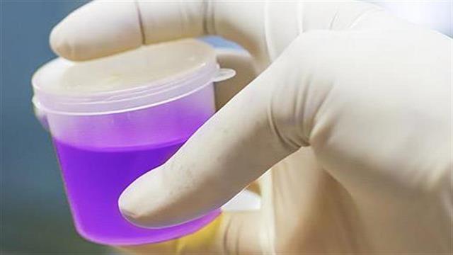 Προβληματισμός γιατρών για το μωβ χρώμα ούρων ασθενούς