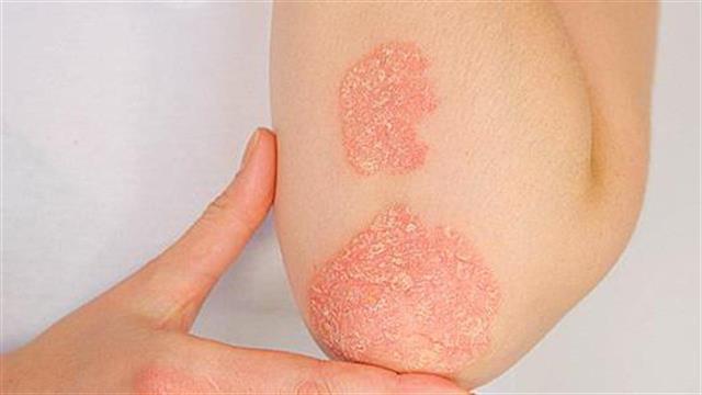 Η πρώτη πανελλήνια πολυκεντρική μελέτη της GENESIS Pharma για την απρεμιλάστη