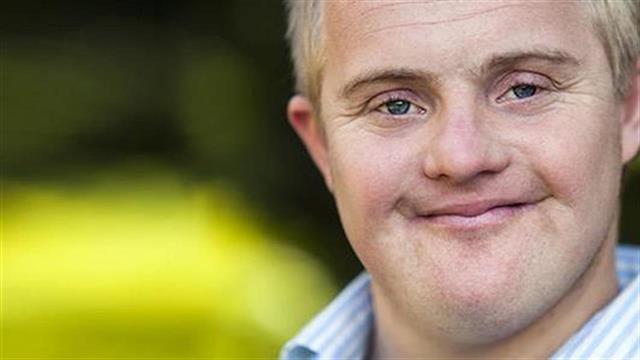 Σύνδρομο Down και αυξημένος κίνδυνος άνοιας στα 55