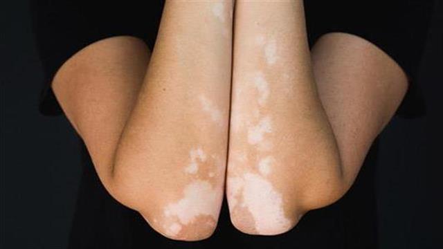 Λεύκη: Ποια είναι η καλύτερη θεραπεία και πόσο πρέπει να διαρκεί;