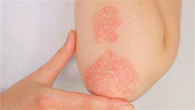 Αυτοάνοσα νοσήματα: Γιατί αυξάνονται στις μέρες μας;