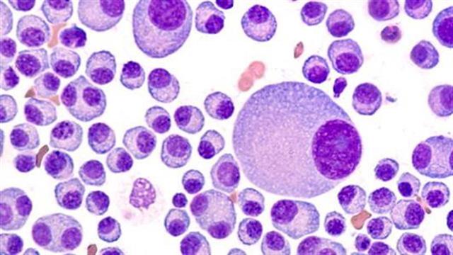 TAKEDA Hellas: Δορυφορικό Συμπόσιο με θέμα τις εξελίξεις στη θεραπεία του Πολλαπλού Μυελώματος και του Λεμφώματος Hodgkin’s