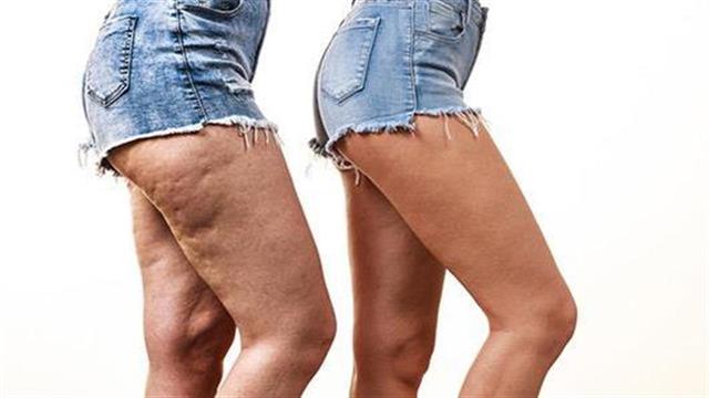 Τελικά φεύγει η κυτταρίτιδα;