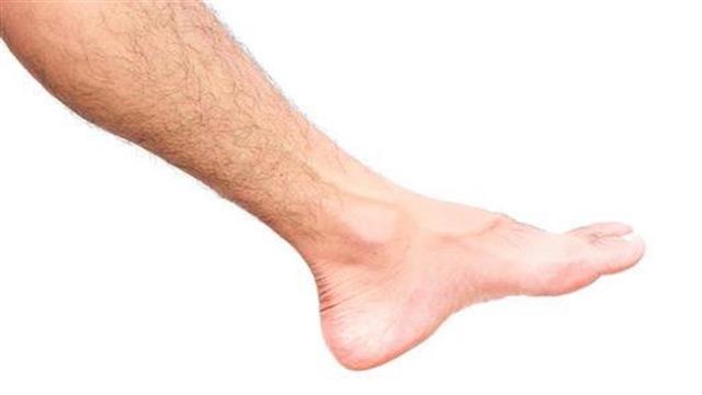 Το μεταβολικό σύνδρομο συνδέεται με την εν τω βάθει φλεβική θρόμβωση