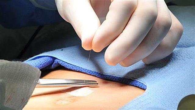 Κήλη: Τι θα συμβεί εάν δεν κάνω εγχείρηση;