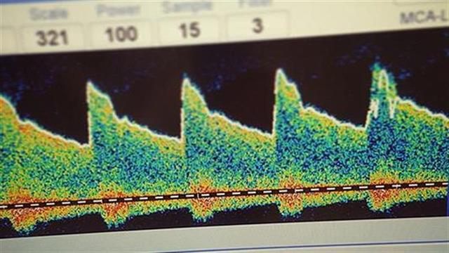 Υπερηχογραφική διερεύνηση ασθενών με αγγειακό εγκεφαλικό επεισόδιο στην πανδημία