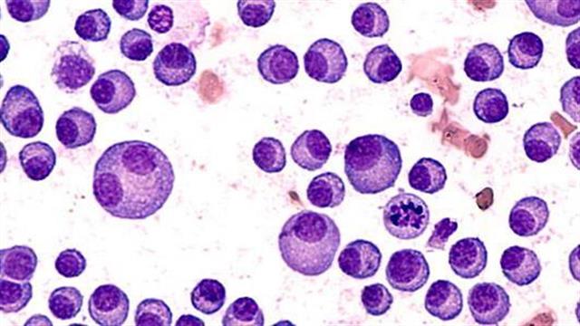 Στα ύψη ο ανταγωνισμός για το πολλαπλούν μυέλωμα