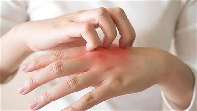 Η τραλοκινουμάμπη στην ατοπική δερματίτιδα