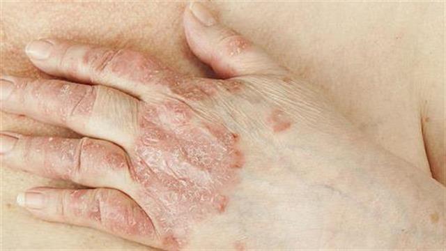 Ερυθροδερμική Ψωρίαση: Πόσο σοβαρή είναι