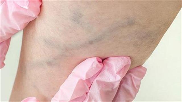 Αναίμακτη και ανώδυνη θεραπεία των κιρσών