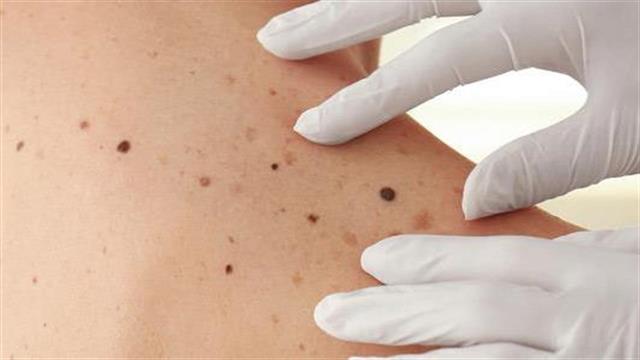 O FDA ενέκρινε μια συνδυαστική θεραπεία για το προχωρημένο μελάνωμα