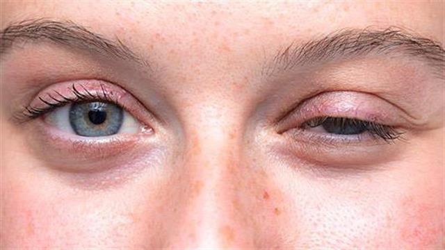 Η COVID-19 μπορεί να προκαλέσει και νευρομυϊκή νόσο