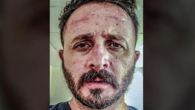 Ακτινολόγος ΠΑΓΝΗ προς αρνητές της μάσκας: "Εμείς παρακαλάμε να την έχουμε"...