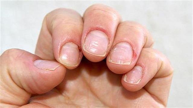 Υπερηχογράφημα στα νύχια: Σε ποιες περιπτώσεις μπορεί να βοηθήσει