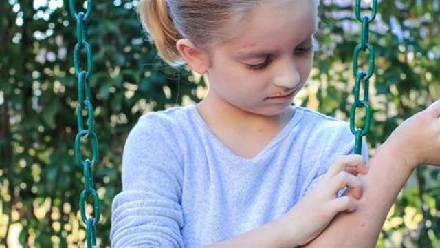 Εξελίξεις στη θεραπεία της ατοπικής δερματίτιδας σε παιδιά