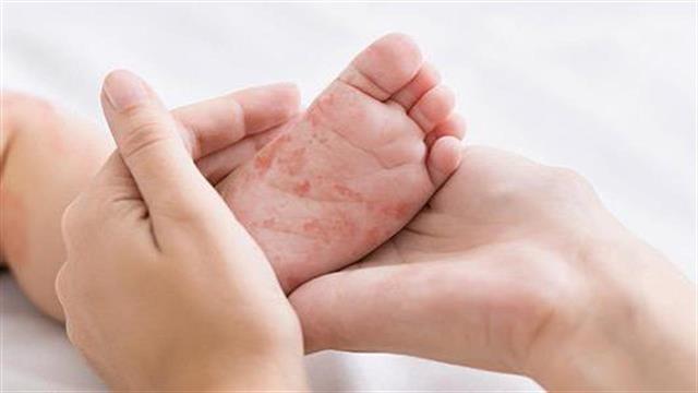 Δεν πρέπει να ξεχνάμε την ιλαρά - Παγκόσμια αύξηση κρουσμάτων