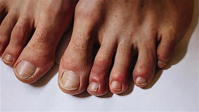 Κορωνοϊός: Σε ποιους διαρκούν τα δερματικά συμπτώματα και πόσο;