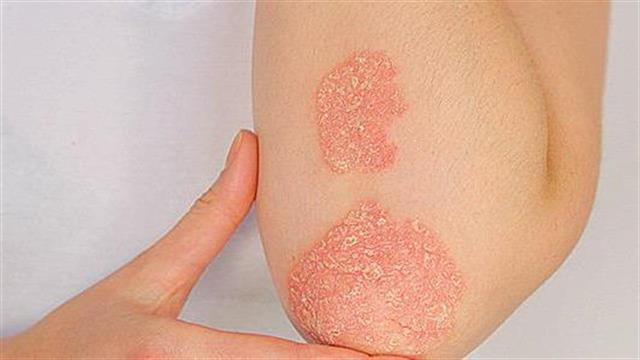 Η φυσική, μη ανοσοκατασταλτική ιατρική θεραπεία ψωρίασης χωρίς φάρμακα