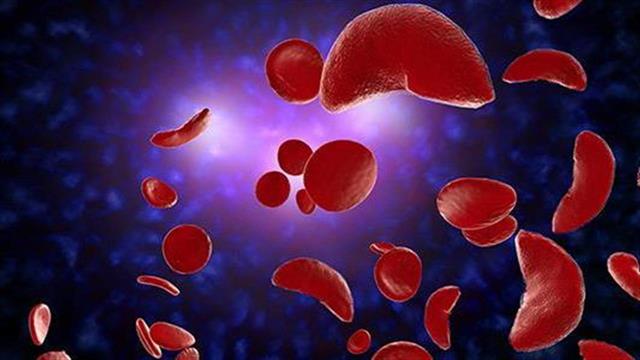 Θα μπορούσε η γονιδιακή θεραπεία να θεραπεύσει τη δρεπανοκυτταρική νόσο;