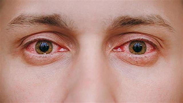 Ο κίνδυνος όσων πάσχουν από το πρωτοπαθές σύνδρομο Sjongren’s